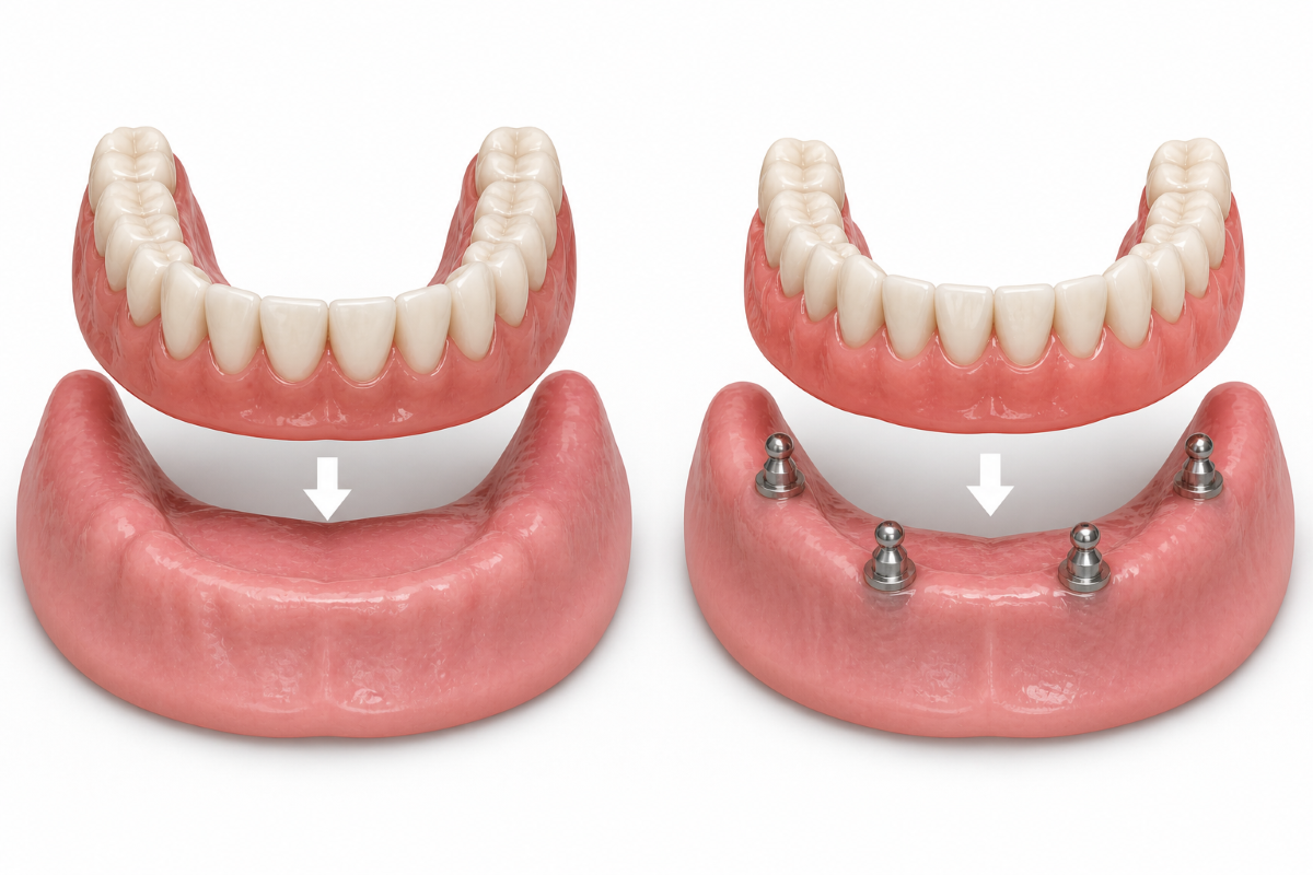Snap-On Dentures vs. Traditional Dentures snap-on-vs-traditional-dentures-houston