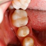 Fillings and sealants