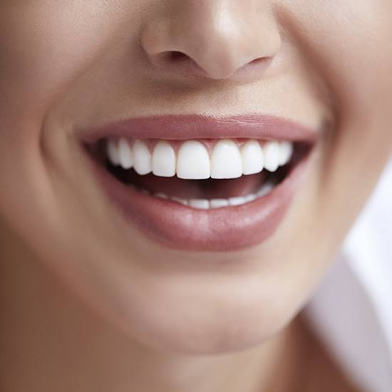 Close-up of white teeth after getting porcelain veneers.