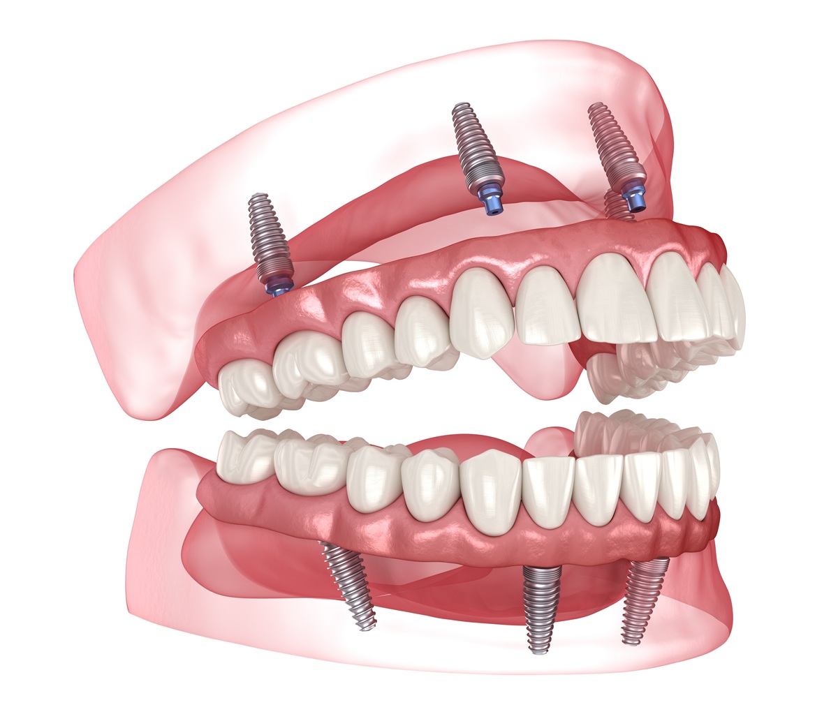 Representación 3D de implantes dentales All-on-4 de boca completa con dentaduras postizas fijas