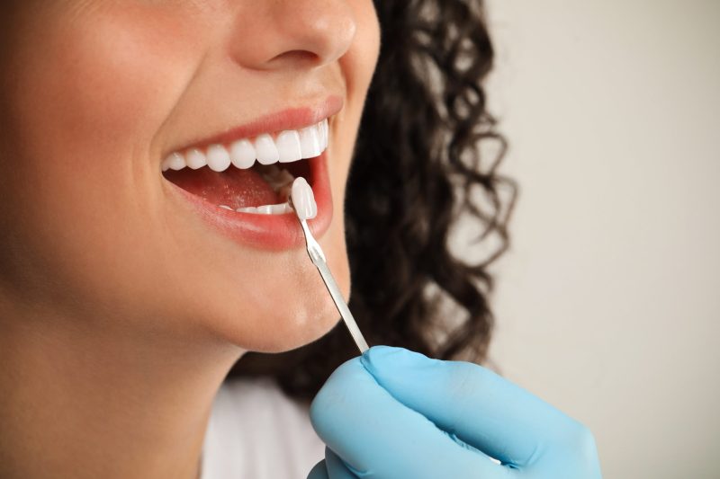 Side view of a woman’s smile with a veneer shade for color matching.