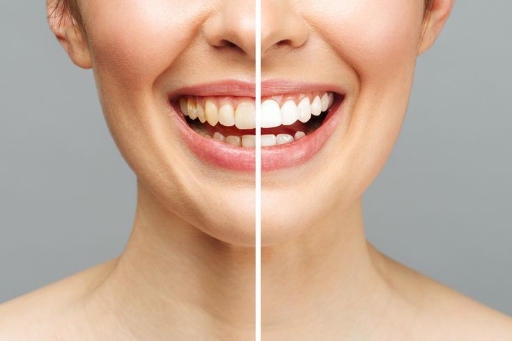 Comparison of teeth before and after getting veneers